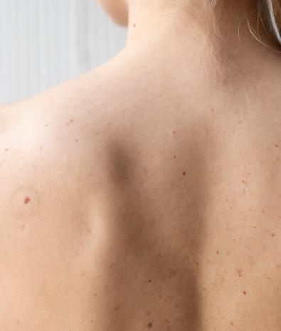 Back Acne Treatment