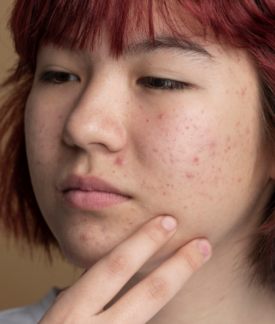 Acne Scar Treatment