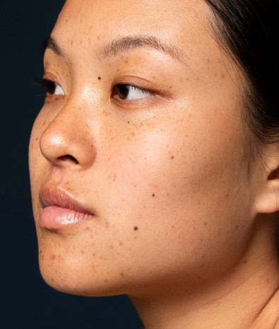 Skin Pigmentation