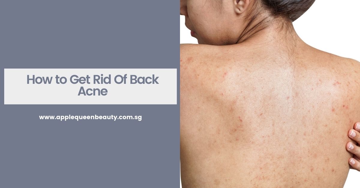 How to Get Rid Of Back Acne Featured Image