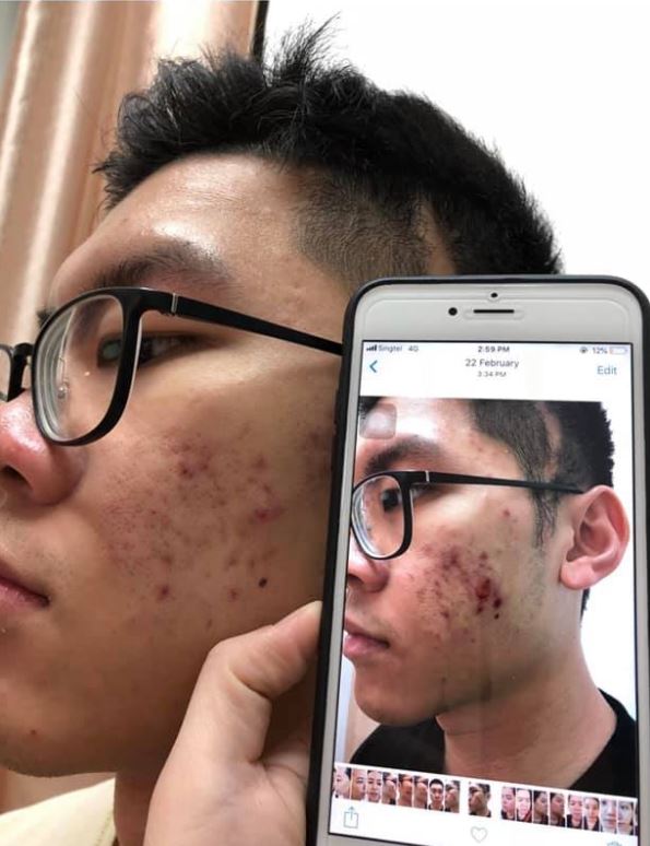 before and after acne scar treatment
