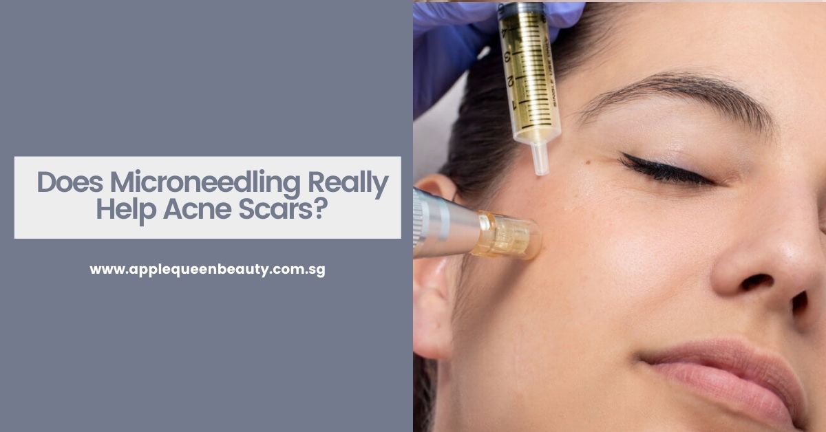 Does Microneedling Really Help Acne Scars Featured Image