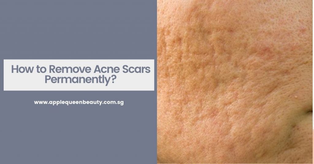 How to Remove Acne Scars Permanently Featured Image