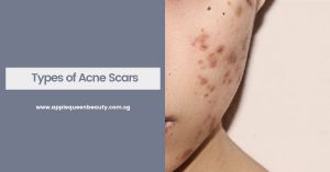 Types of Acne Scars Featured Image