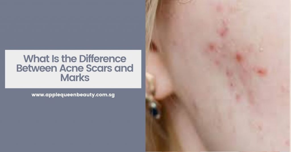 What Is the Difference Between Acne Scars and Marks Featured Image