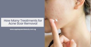 How Many Treatments for Acne Scar Removal Featured Image