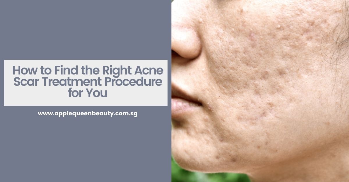 How to Find the Right Acne Scar Treatment Procedure for You