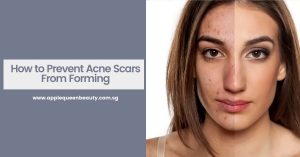 How to Prevent Acne Scars From Forming