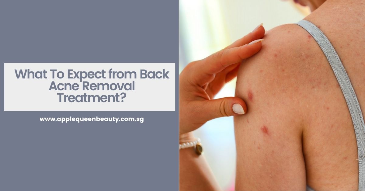 What To Expect from Back Acne Removal Treatment?