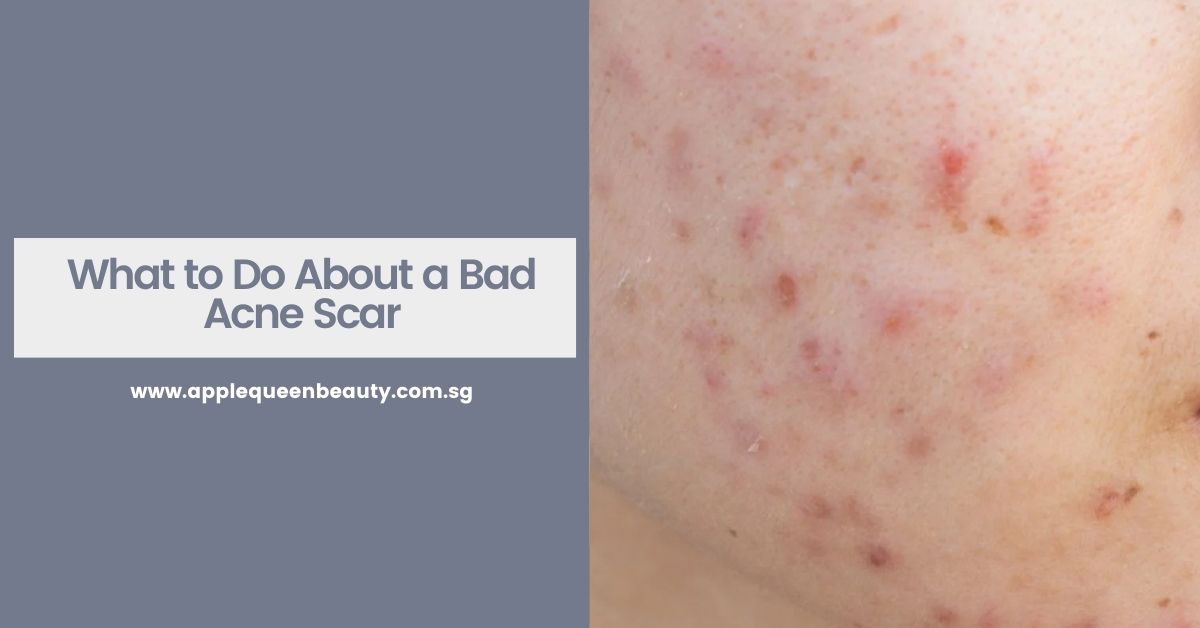 What to Do About a Bad Acne Scar Featured Image