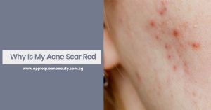 Why Is My Acne Scar Red?