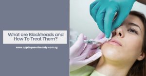 What are Blackheads and How To Treat Them Featured Image