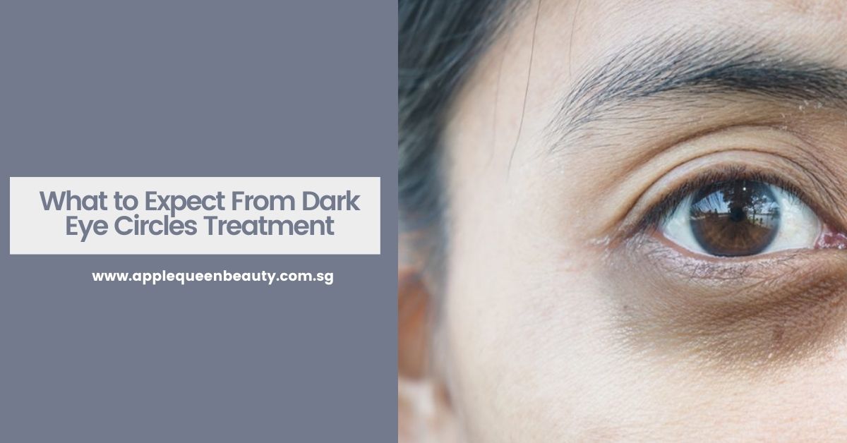 What to Expect From Dark Eye Circles Treatment