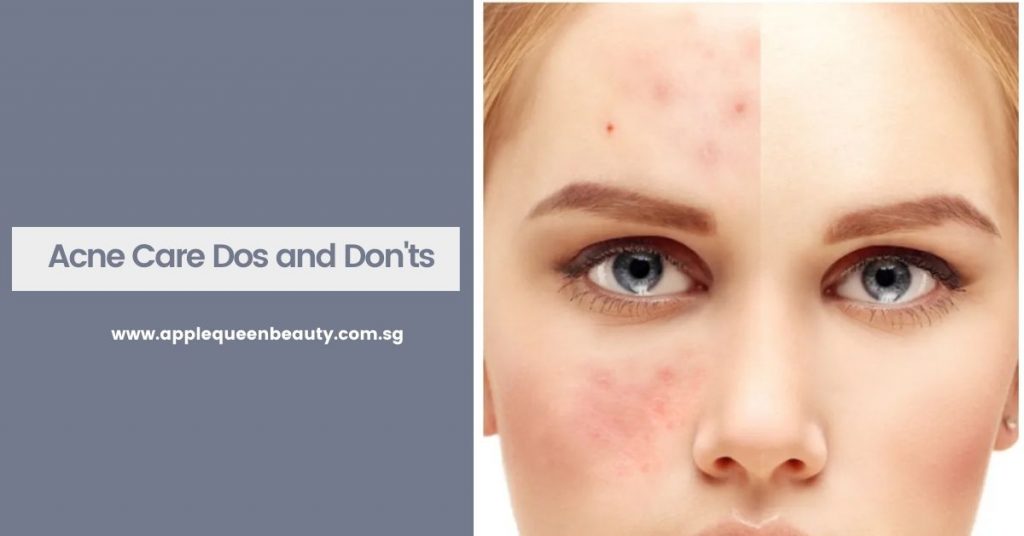 Acne Care Dos and Donts Featured Image