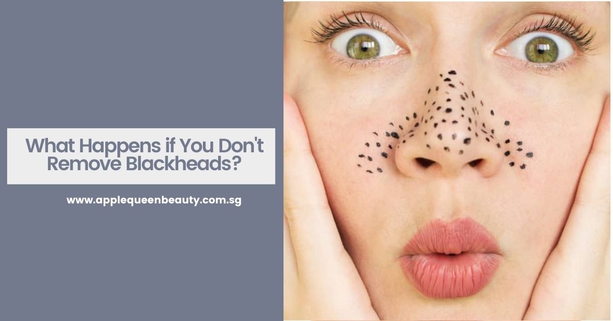 What Happens if You Don't Remove Blackheads