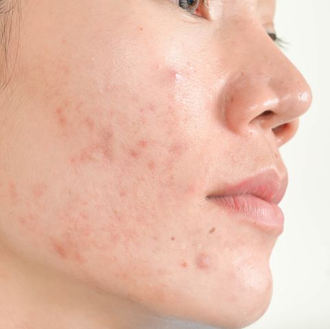 why do adults have acne