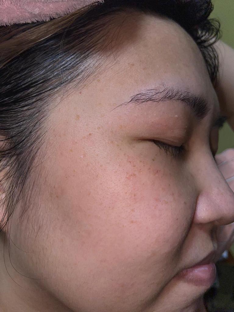 pigmentation freckle after recovery 1
