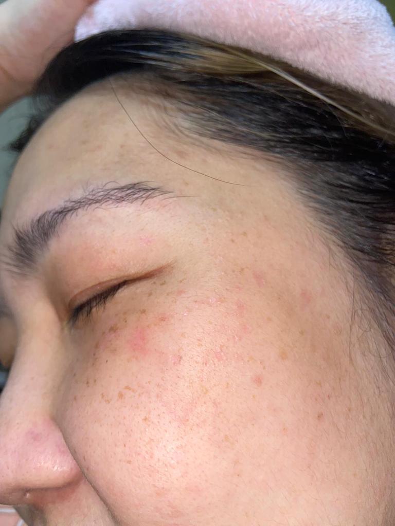 pigmentation freckle after recovery