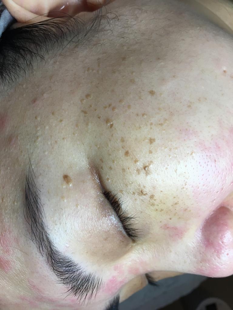 pigmentation freckle before